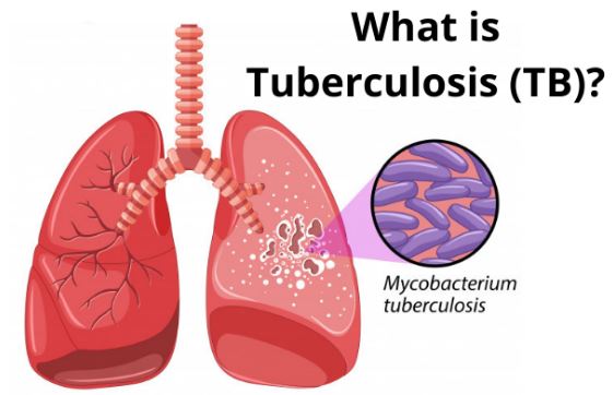 TB Causes : वर्ल्ड ट्यूबरक्यूलोसिस (TB) डे आज, टीबी के मामलों में भारत नंबर 1