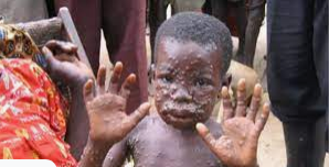 Monkeypox: बुखार, चकत्ते और दर्द हैं मंकीपॉक्स के लक्षण, जानें कैसे