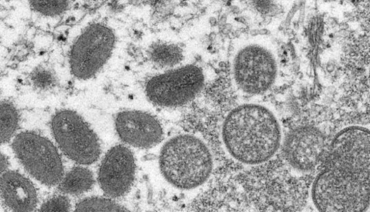 There is a worldwide stir regarding monkeypox, UP government also issued advisory