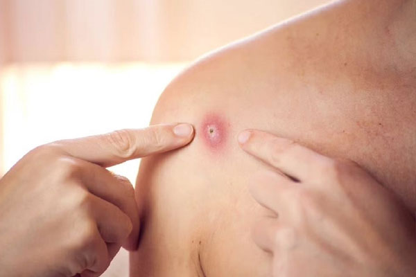 उत्तर प्रदेश, लखनऊ, योगी आदित्यनाथ सरकार, मंकी पॉक्स, Uttar Pradesh, Lucknow, Yogi Adityanath Sarkar, Monkey Pox