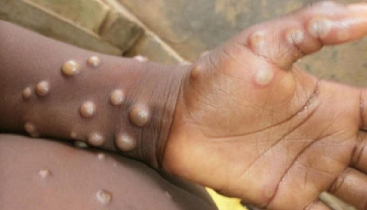 उत्तर प्रदेश, लखनऊ, गाजियाबाद, मंकीपॉक्स संक्रमण, Uttar Pradesh, Lucknow, Ghaziabad, Monkeypox infection