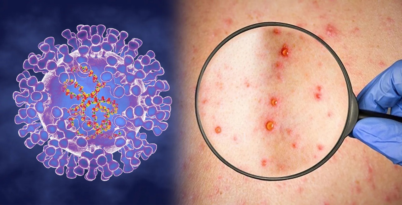 मंकीपॉक्स, मंकीपॉक्स के लक्षण, मंकीपॉक्स से बचाव, केंद्र सरकार, monkeypox, symptoms of monkeypox, prevention of monkeypox, central government,