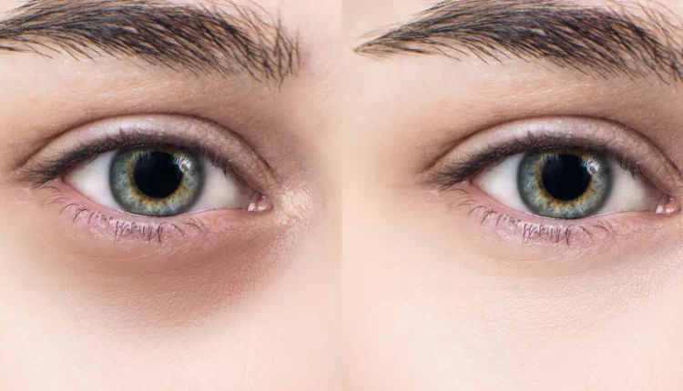 डार्क सर्कल, सेहत, स्वास्थ्य , आंखों के नीचे काले घेरे, dark circles health health dark circles under eyes