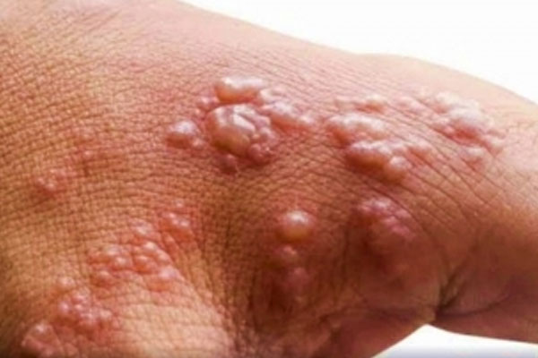 first case of monkeypox reported in delhi, monkeypox, hindi news, news in hindi, breaking news in hindi, real time news