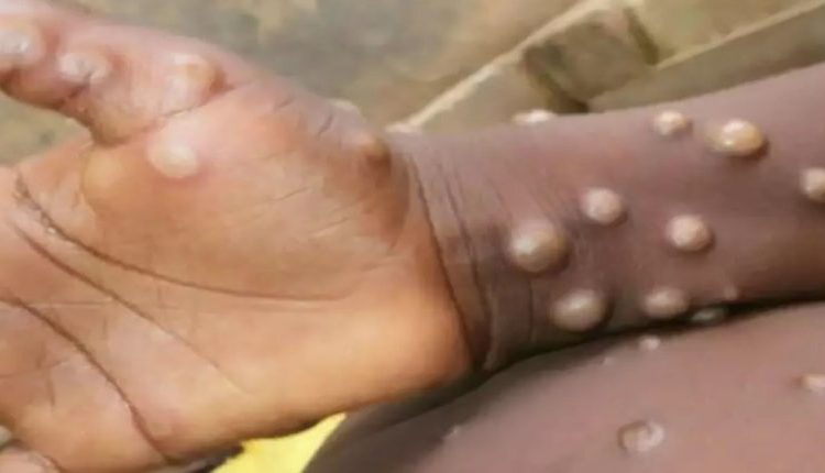 दिल्ली, दिल्ली में मंकीपॉक्स, मंकीपॉक्स, Monkeypox in Delhi, Monkeypox in Delhi